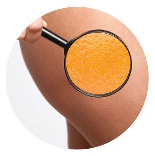 Targets Cellulite and Fat Deposits