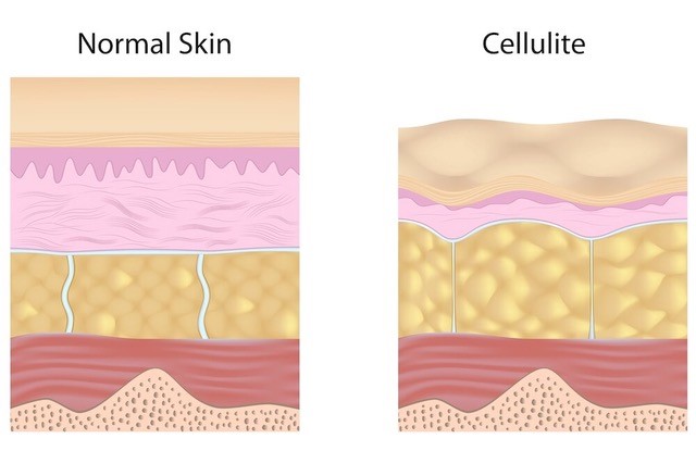 Schema Cellulite